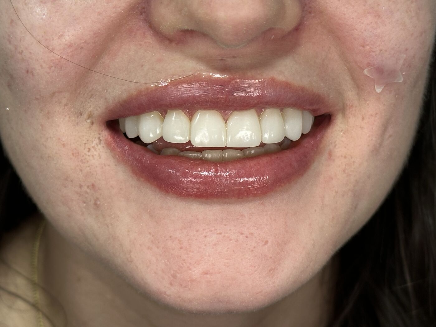 Sonrisa caso 3