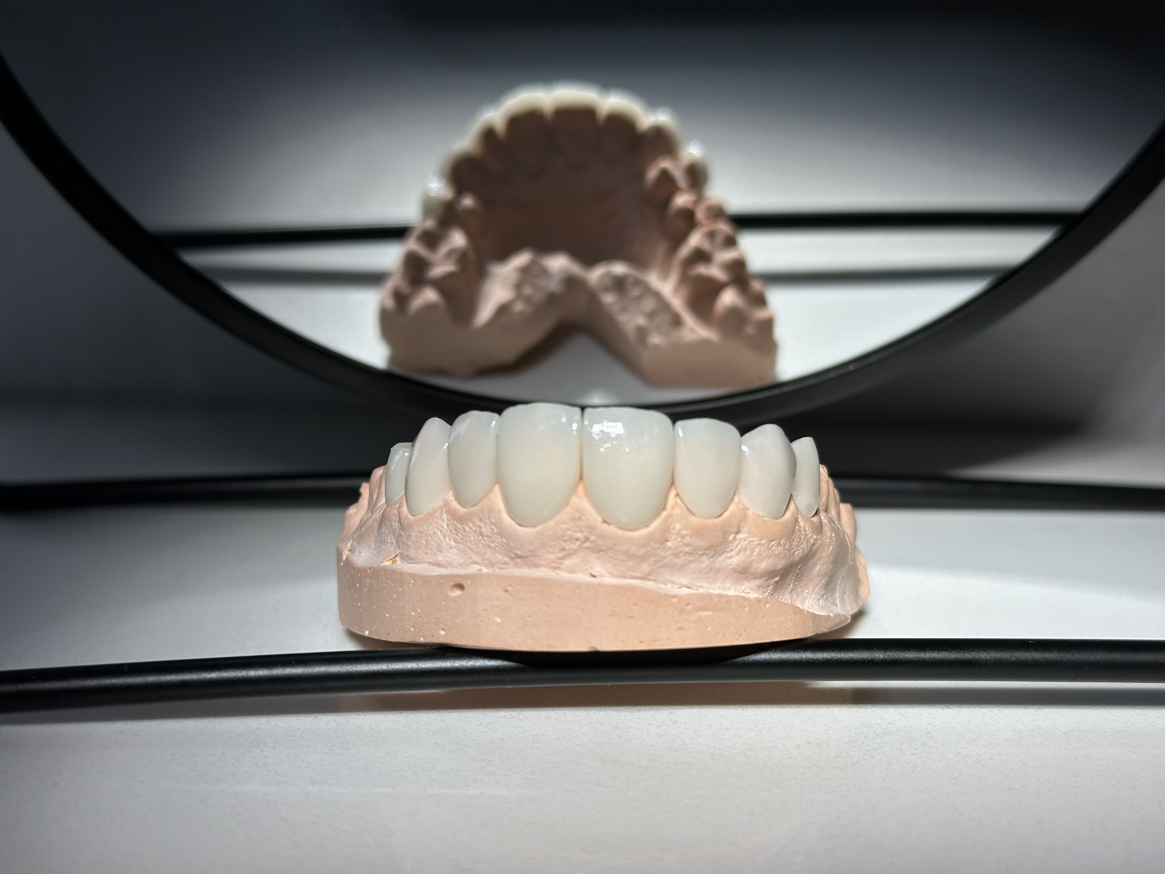 Modelo de diseño de sonrisa en cerámica