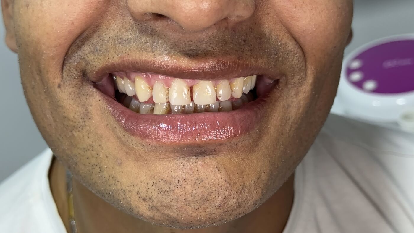 Antes del tratamiento de diseño de sonrisa