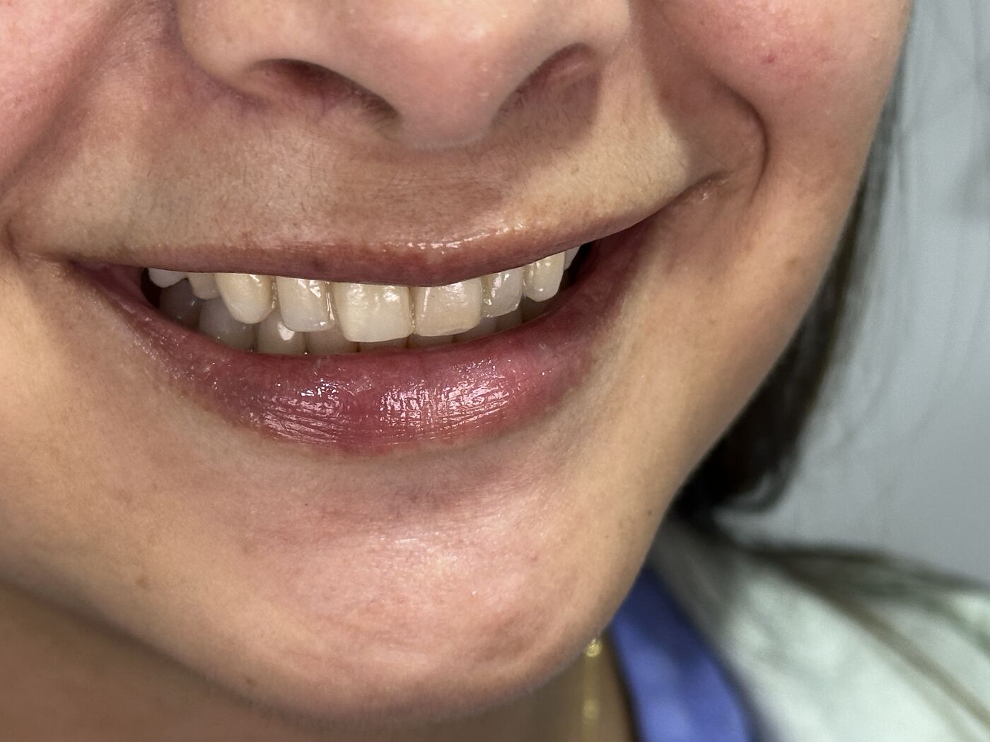 Antes del diseño de sonrisa