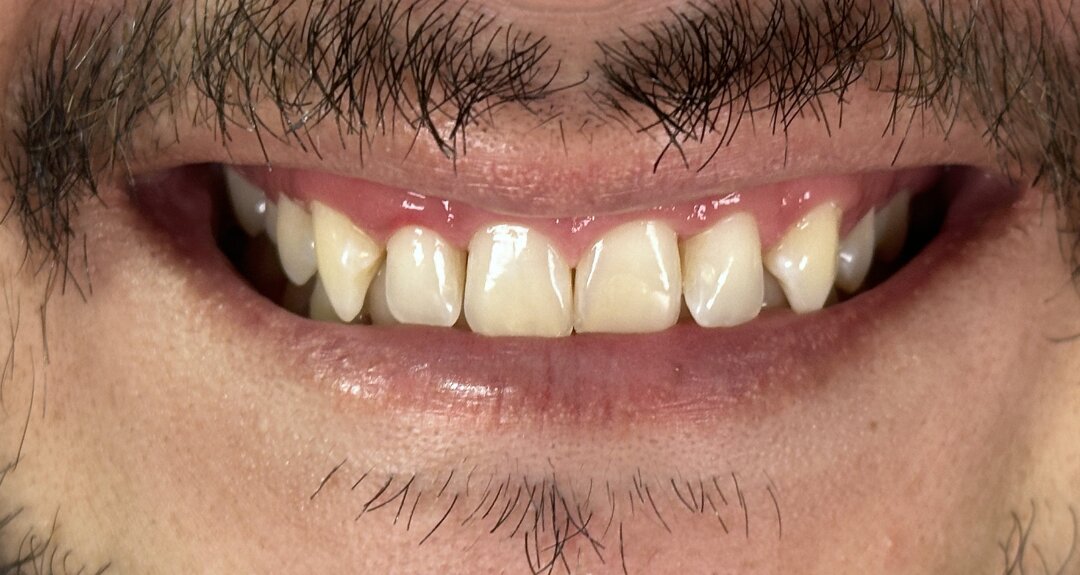 Antes del tratamiento de diseño de sonrisa