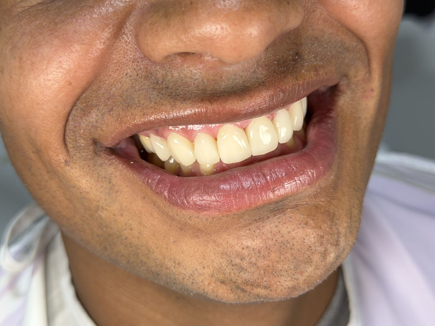 Después del tratamiento — sonrisa transformada