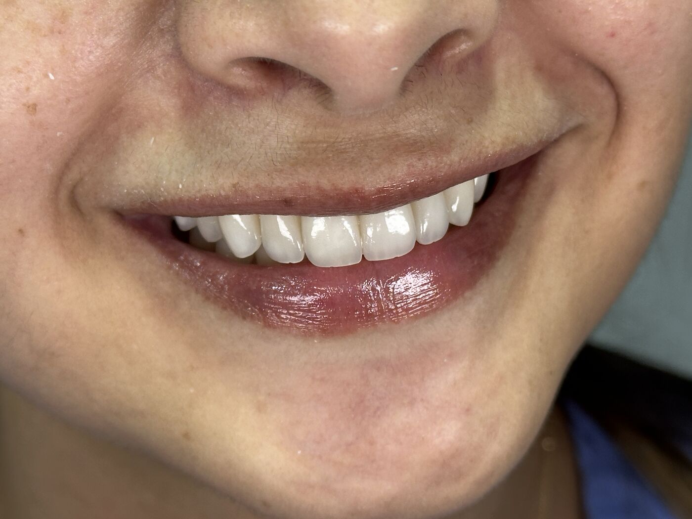 Después — sonrisa transformada con cerámica