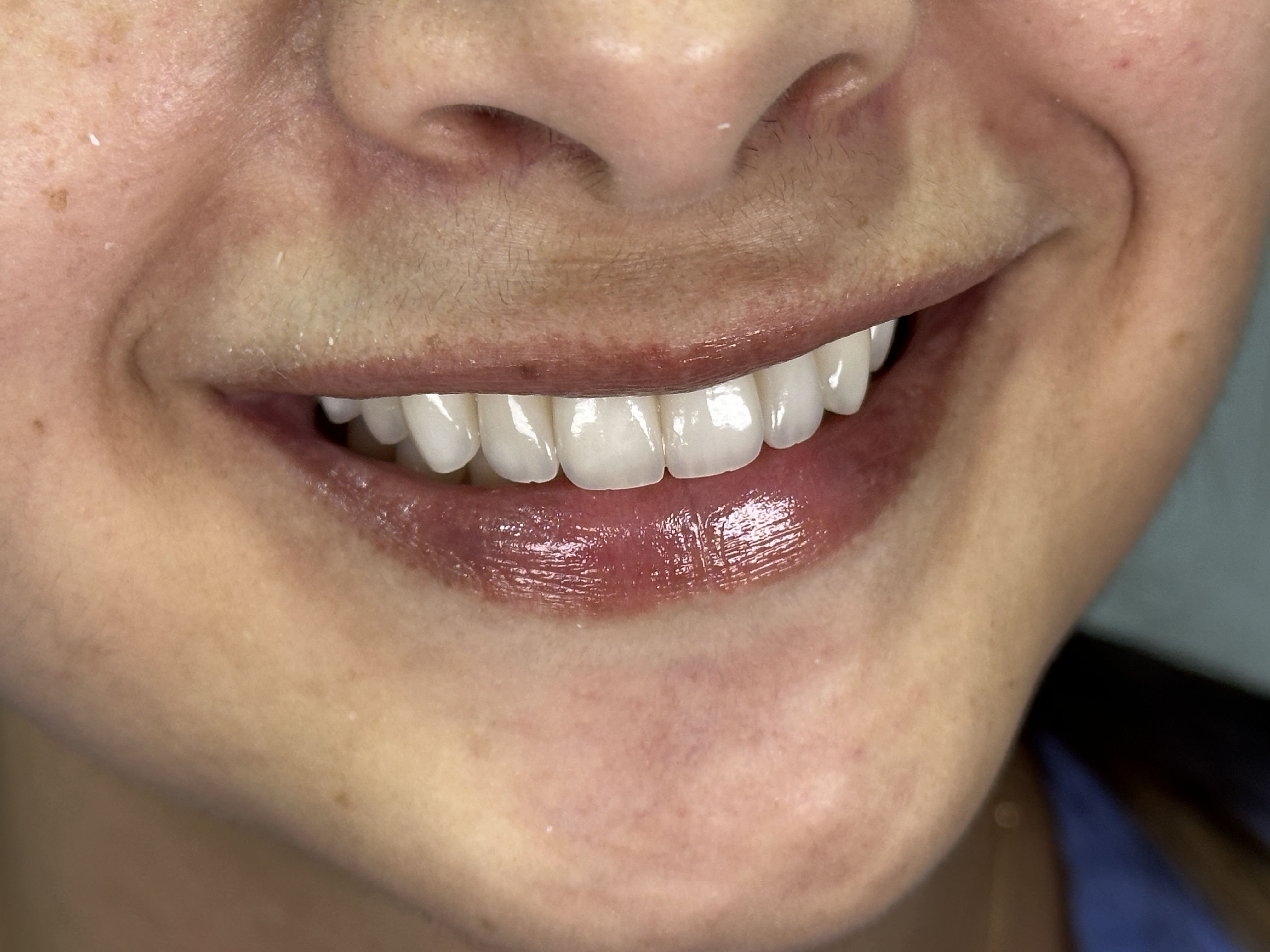 Después — sonrisa transformada con cerámica