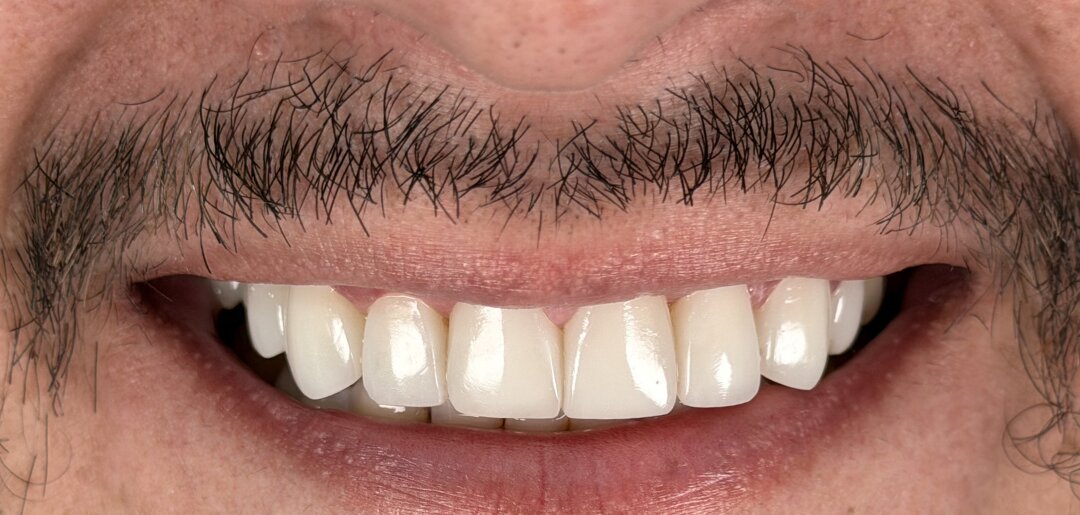 Después del tratamiento — sonrisa transformada