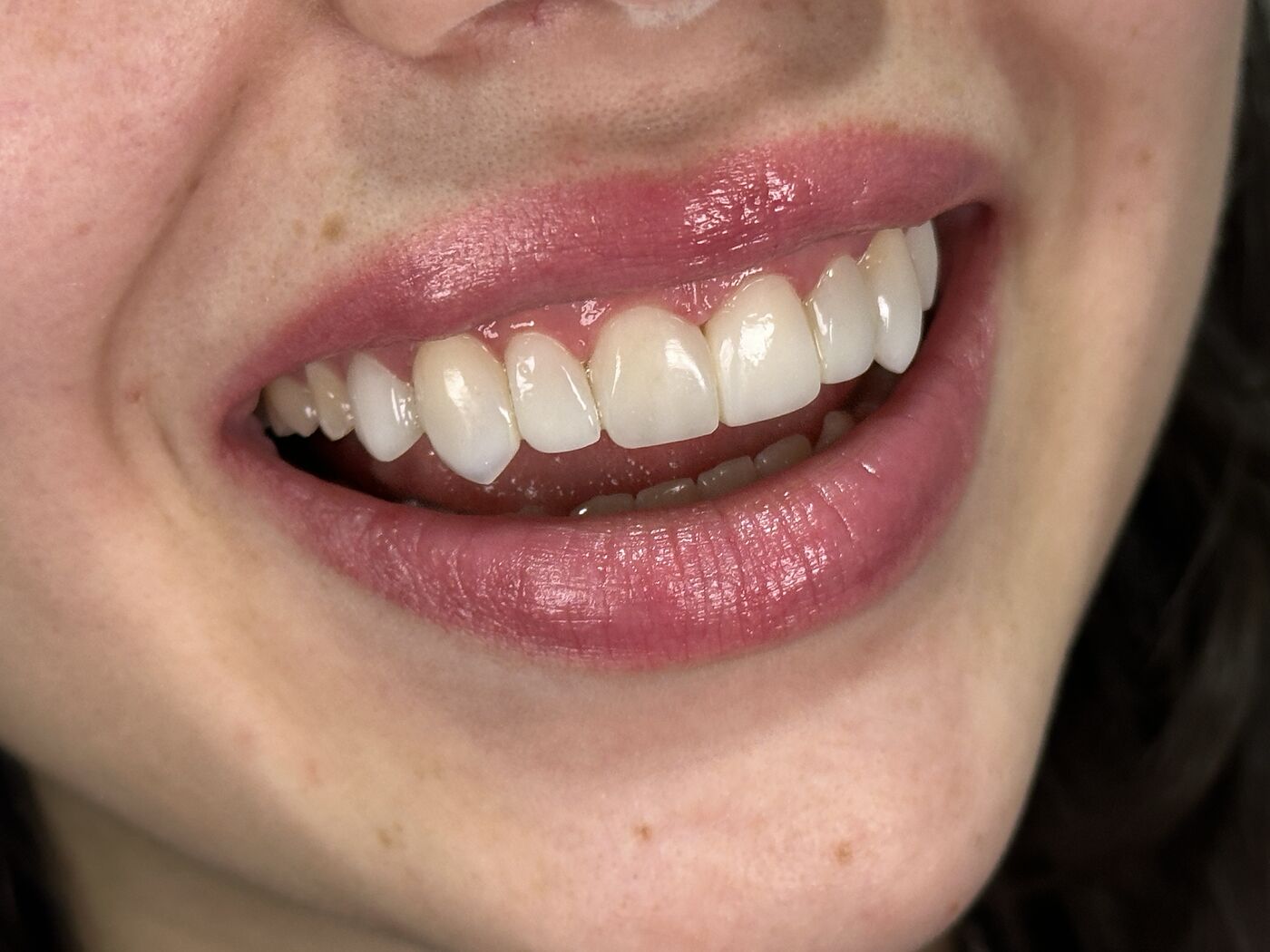Sonrisa caso 1