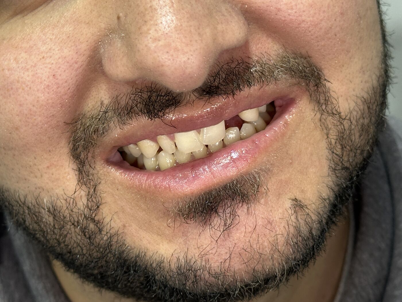 Antes del tratamiento de diseño de sonrisa