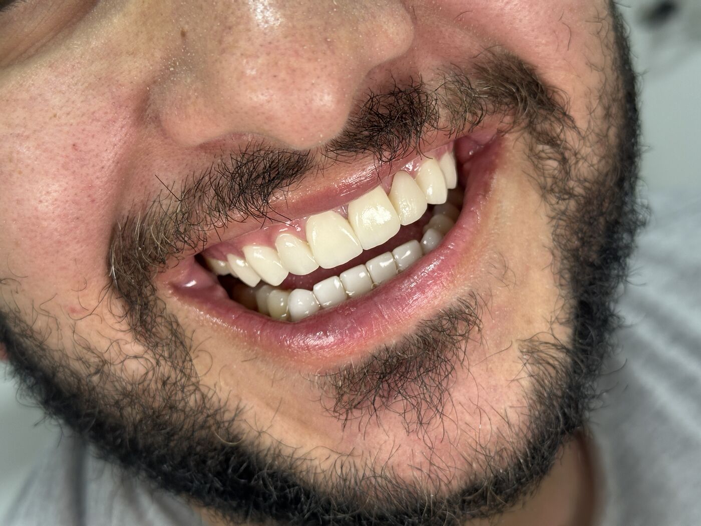 Después del tratamiento — sonrisa transformada