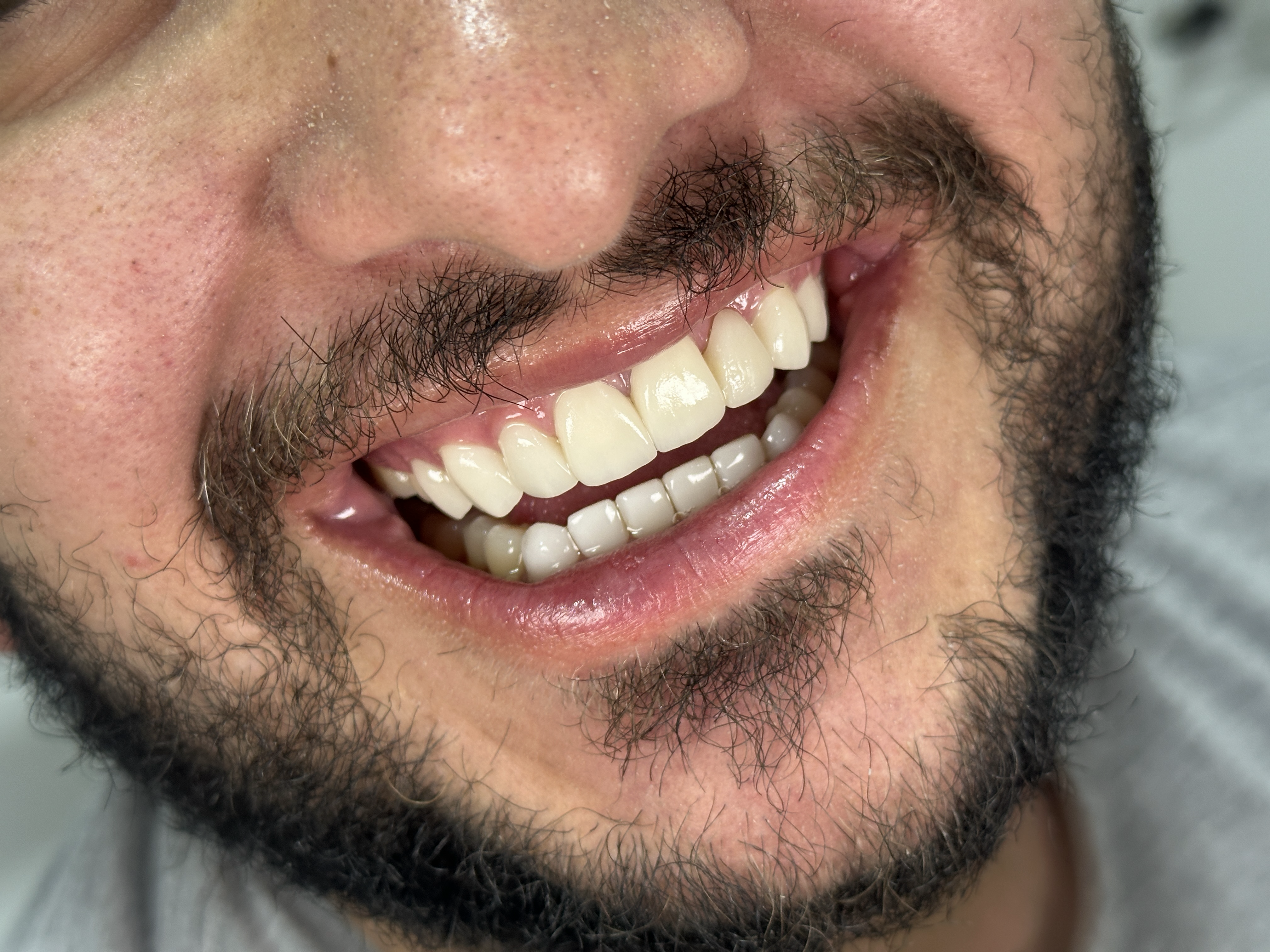 Después del tratamiento — sonrisa transformada